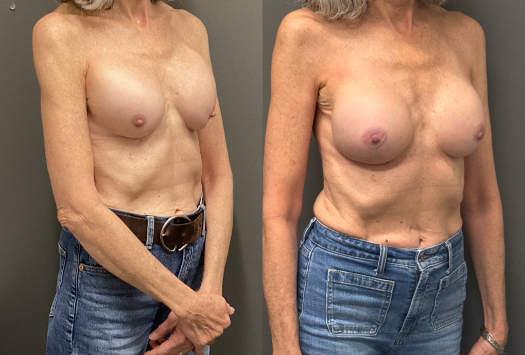 REVISIONS Before & After Gallery - Patient 419522 - Image 2