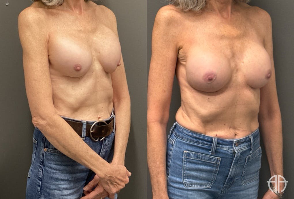 REVISIONS Before & After Gallery - Patient 419522 - Image 2