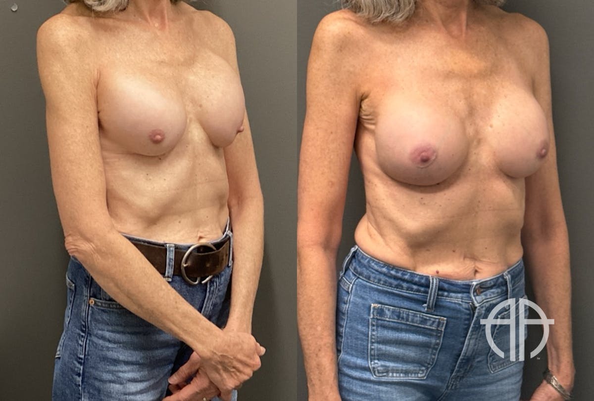 REVISIONS Before & After Gallery - Patient 419522 - Image 2