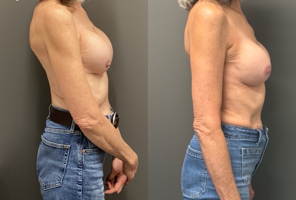 REVISIONS Before & After Gallery - Patient 419522 - Image 3