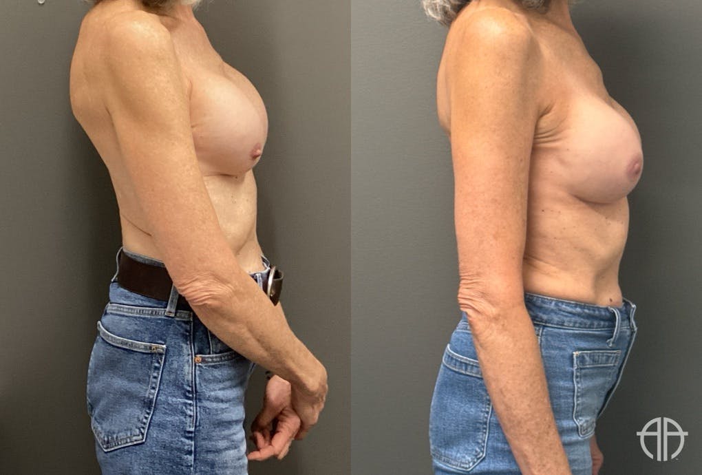 REVISIONS Before & After Gallery - Patient 419522 - Image 3