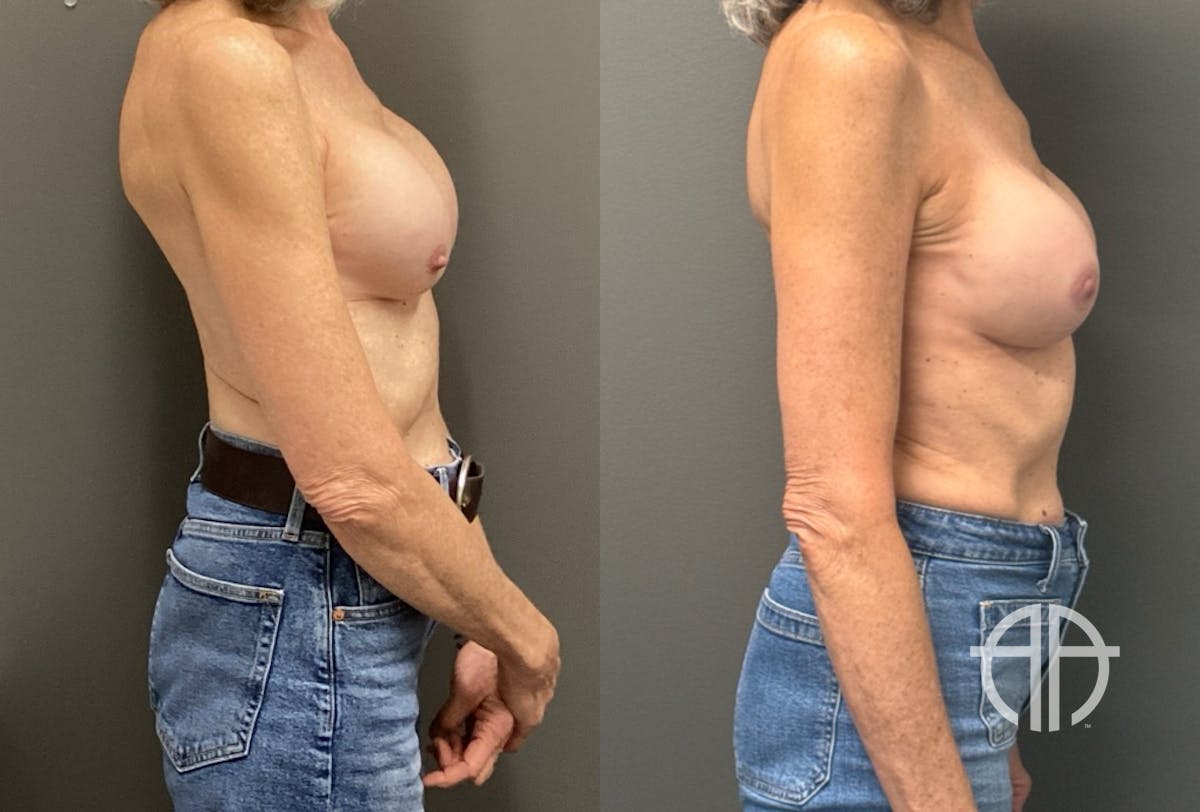 REVISIONS Before & After Gallery - Patient 419522 - Image 3