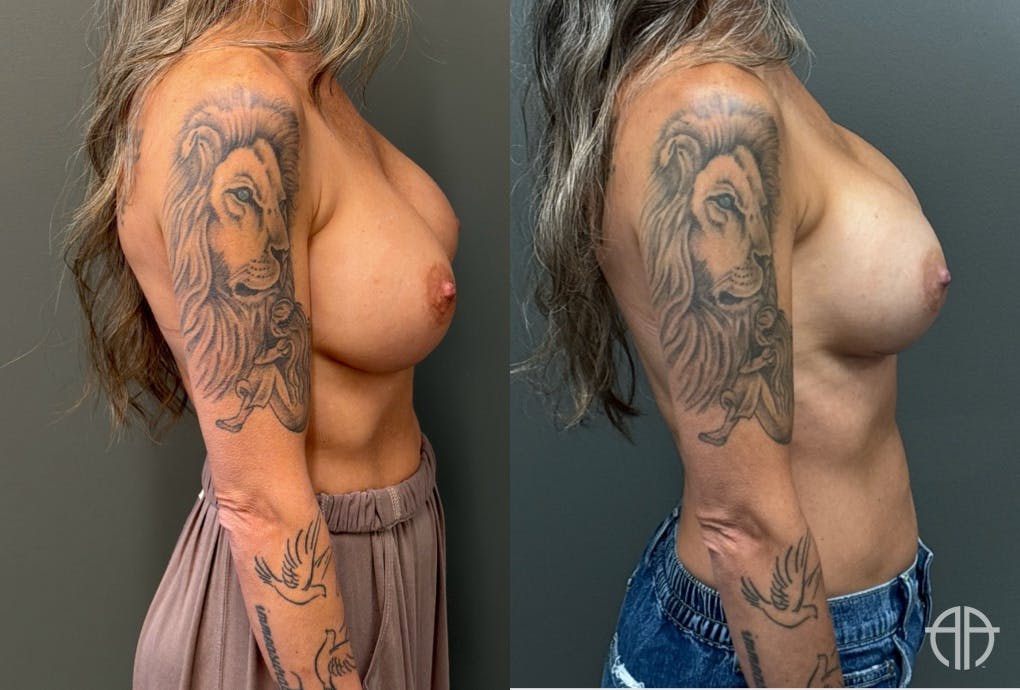 REVISIONS Before & After Gallery - Patient 103704 - Image 3