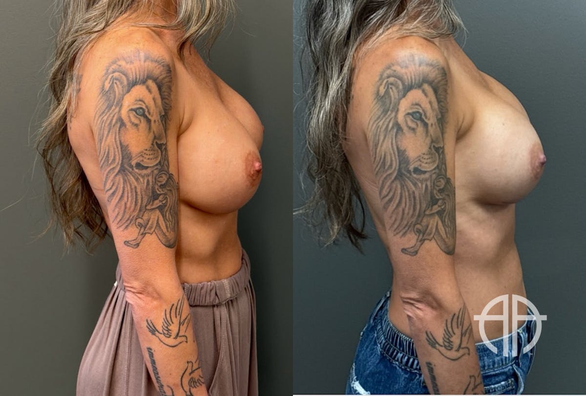 REVISIONS Before & After Gallery - Patient 103704 - Image 3