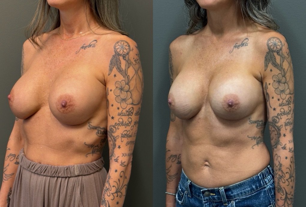 REVISIONS Before & After Gallery - Patient 103704 - Image 4
