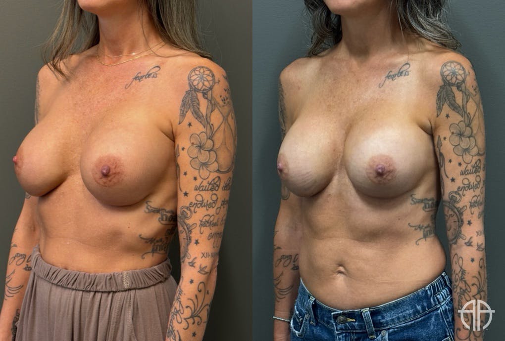 REVISIONS Before & After Gallery - Patient 103704 - Image 4