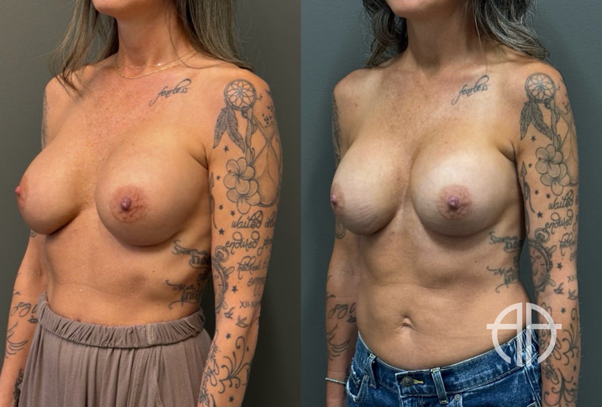 REVISIONS Before & After Gallery - Patient 103704 - Image 4