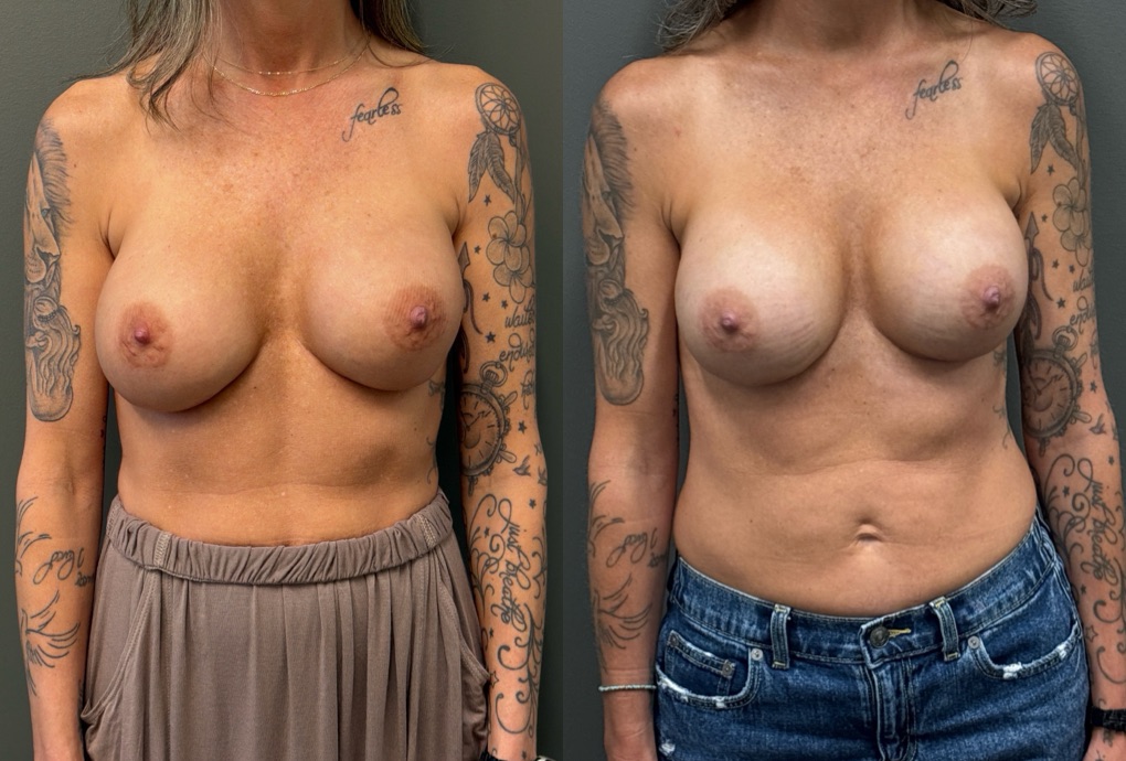 REVISIONS Before & After Gallery - Patient 103704 - Image 1