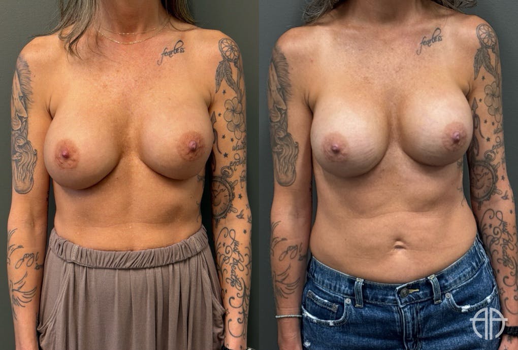 REVISIONS Before & After Gallery - Patient 103704 - Image 1