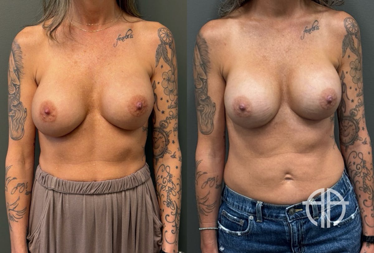 REVISIONS Before & After Gallery - Patient 103704 - Image 1