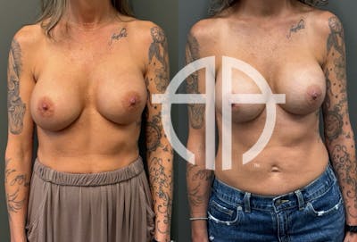 REVISIONS Before & After Gallery - Patient 103704 - Image 1