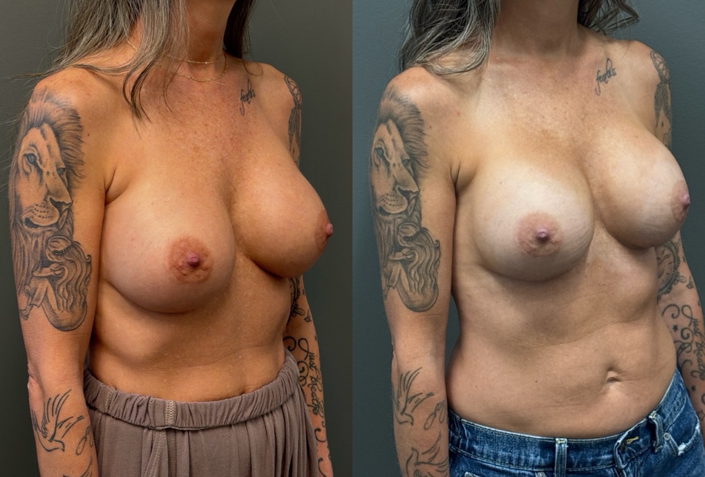 REVISIONS Before & After Gallery - Patient 103704 - Image 2