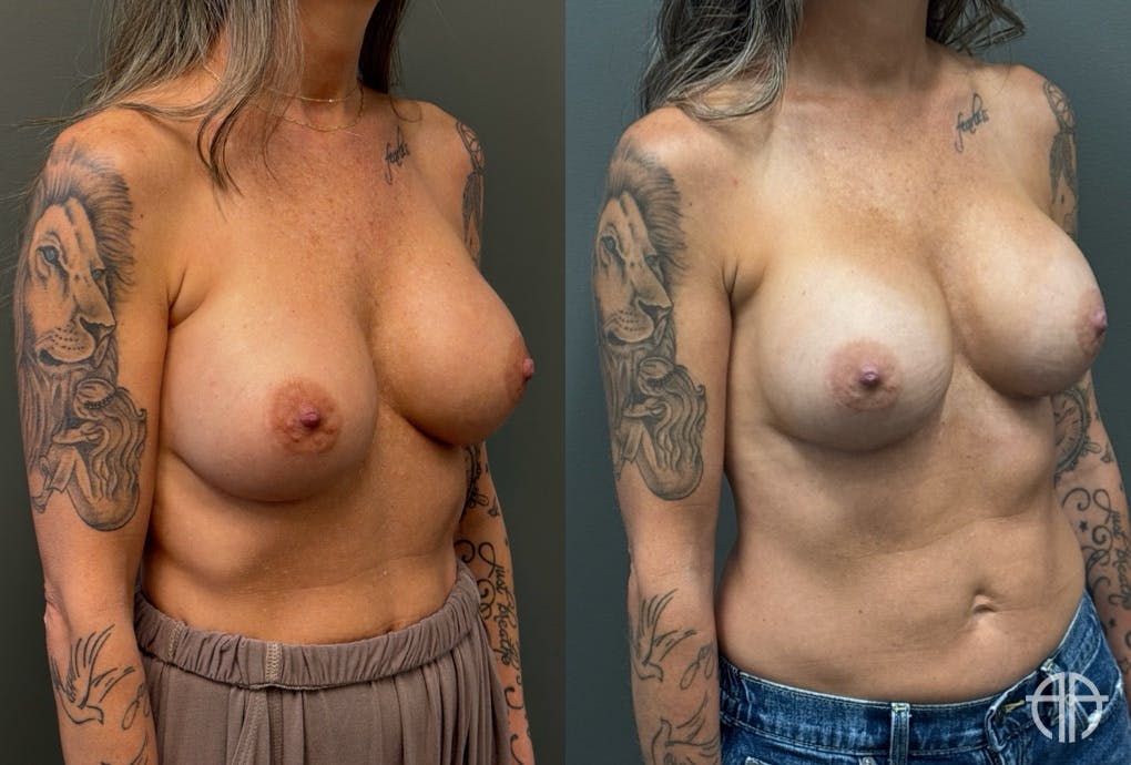REVISIONS Before & After Gallery - Patient 103704 - Image 2