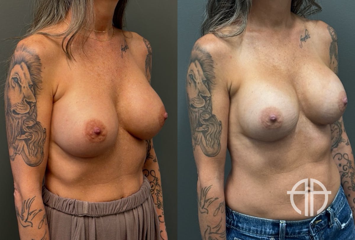 REVISIONS Before & After Gallery - Patient 103704 - Image 2