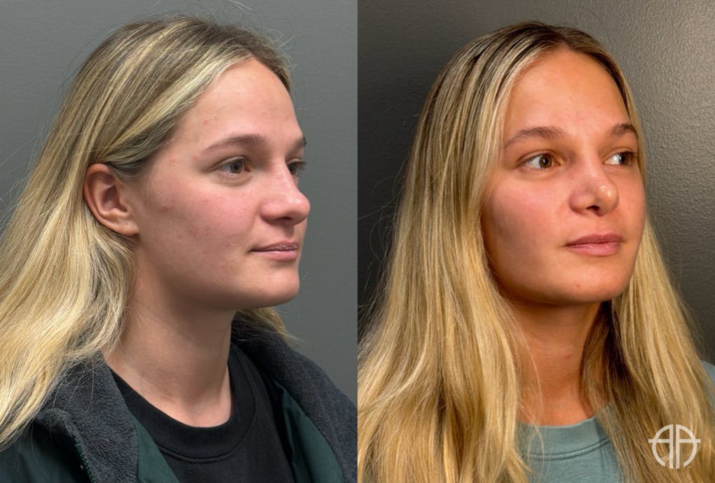 RHINOPLASTY Before & After Gallery - Patient 402620 - Image 2