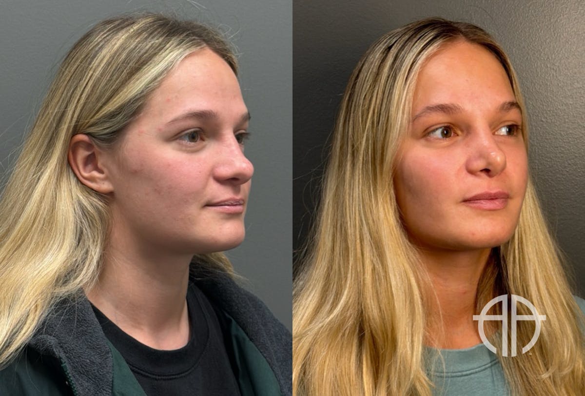 RHINOPLASTY Before & After Gallery - Patient 402620 - Image 2