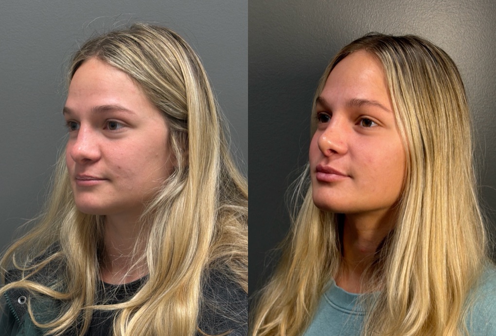 RHINOPLASTY Before & After Gallery - Patient 402620 - Image 4