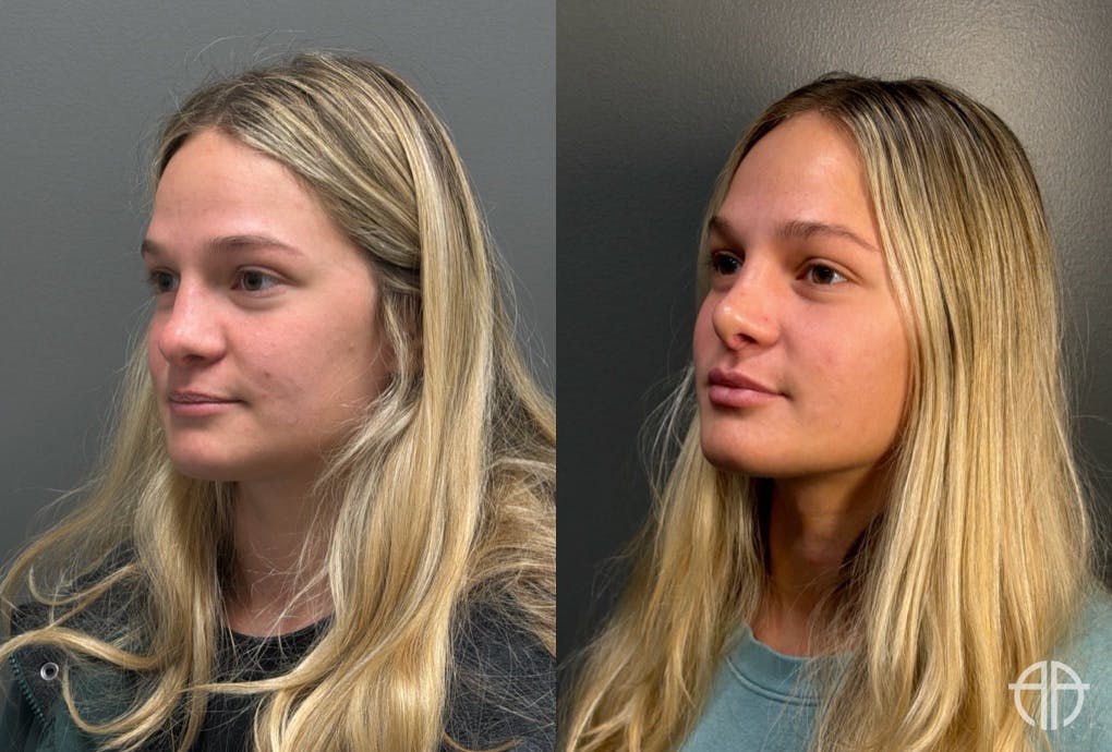 RHINOPLASTY Before & After Gallery - Patient 402620 - Image 4