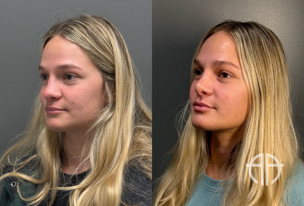 RHINOPLASTY Before & After Gallery - Patient 402620 - Image 4