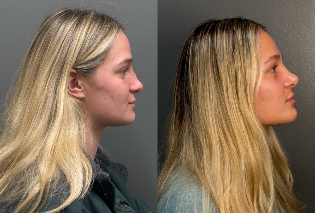 RHINOPLASTY Before & After Gallery - Patient 402620 - Image 3