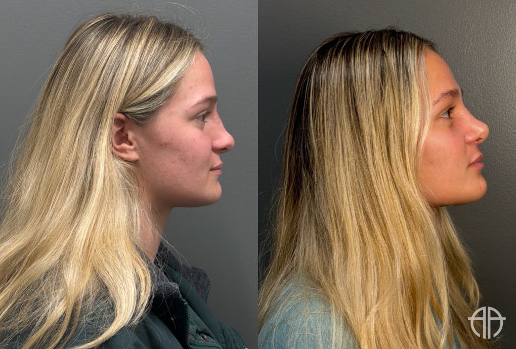 RHINOPLASTY Before & After Gallery - Patient 402620 - Image 3