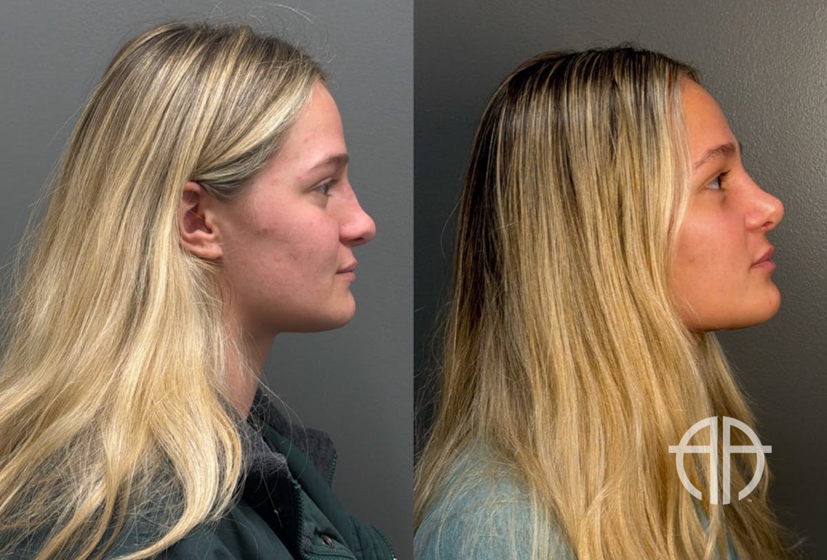 RHINOPLASTY Before & After Gallery - Patient 402620 - Image 3