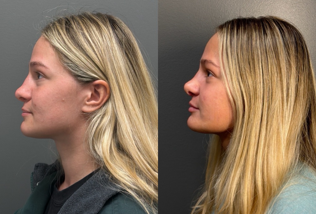 RHINOPLASTY Before & After Gallery - Patient 402620 - Image 5