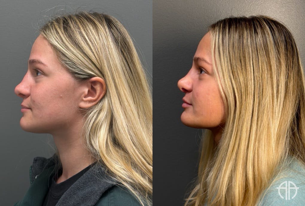 RHINOPLASTY Before & After Gallery - Patient 402620 - Image 5