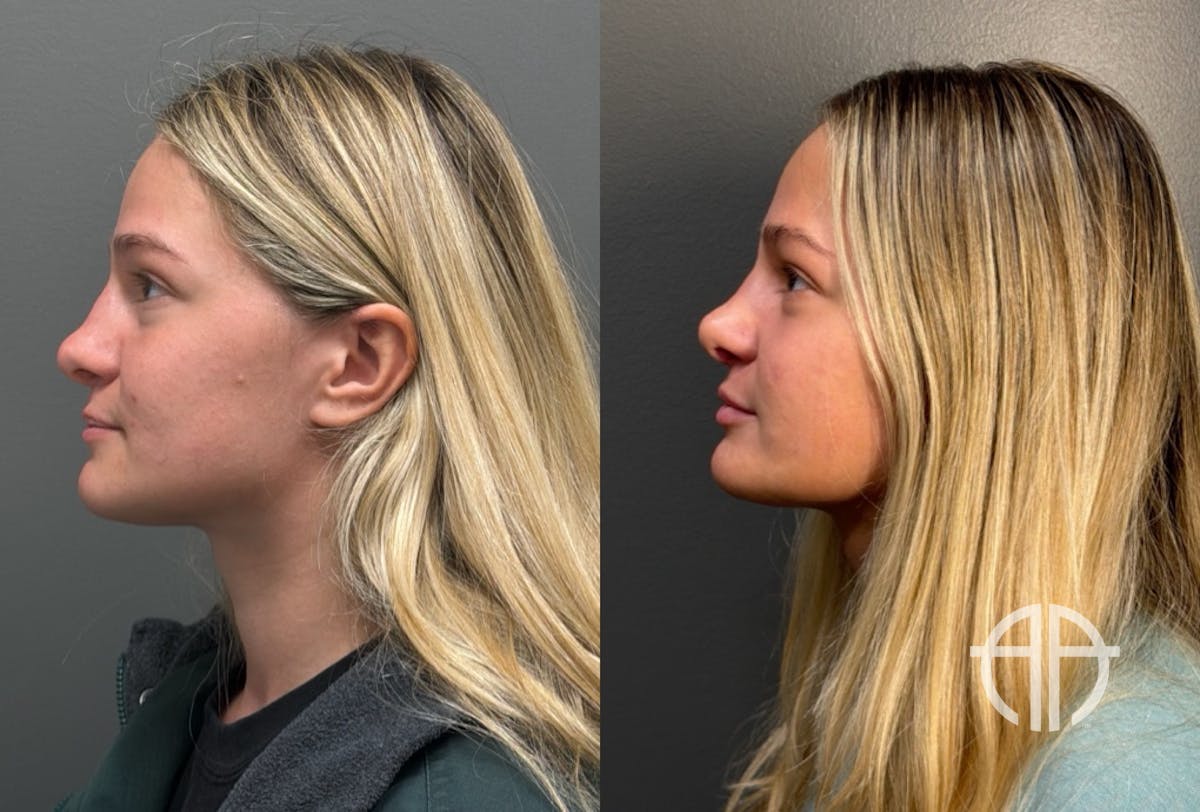 RHINOPLASTY Before & After Gallery - Patient 402620 - Image 5