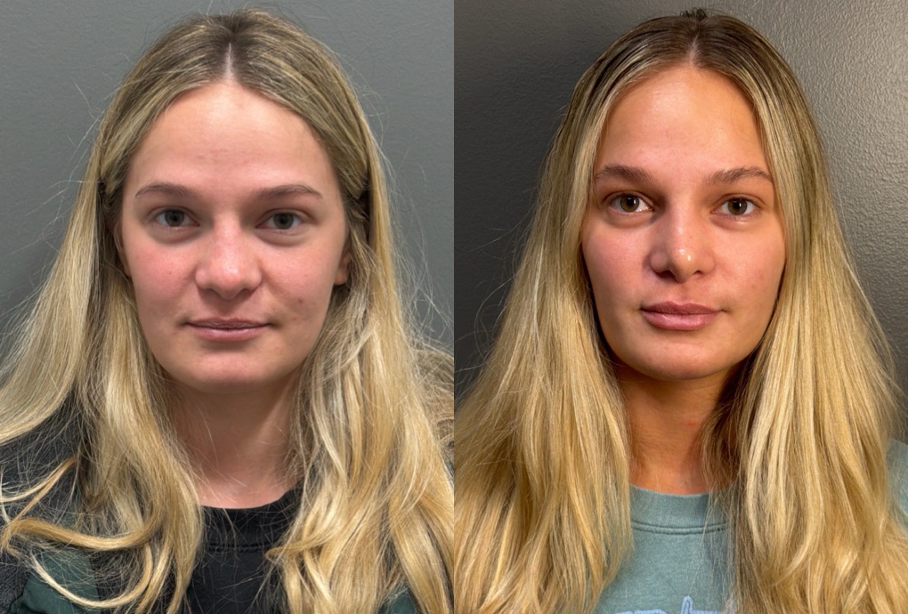 RHINOPLASTY Before & After Gallery - Patient 402620 - Image 1