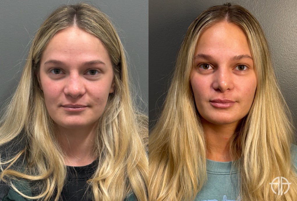 RHINOPLASTY Before & After Gallery - Patient 402620 - Image 1