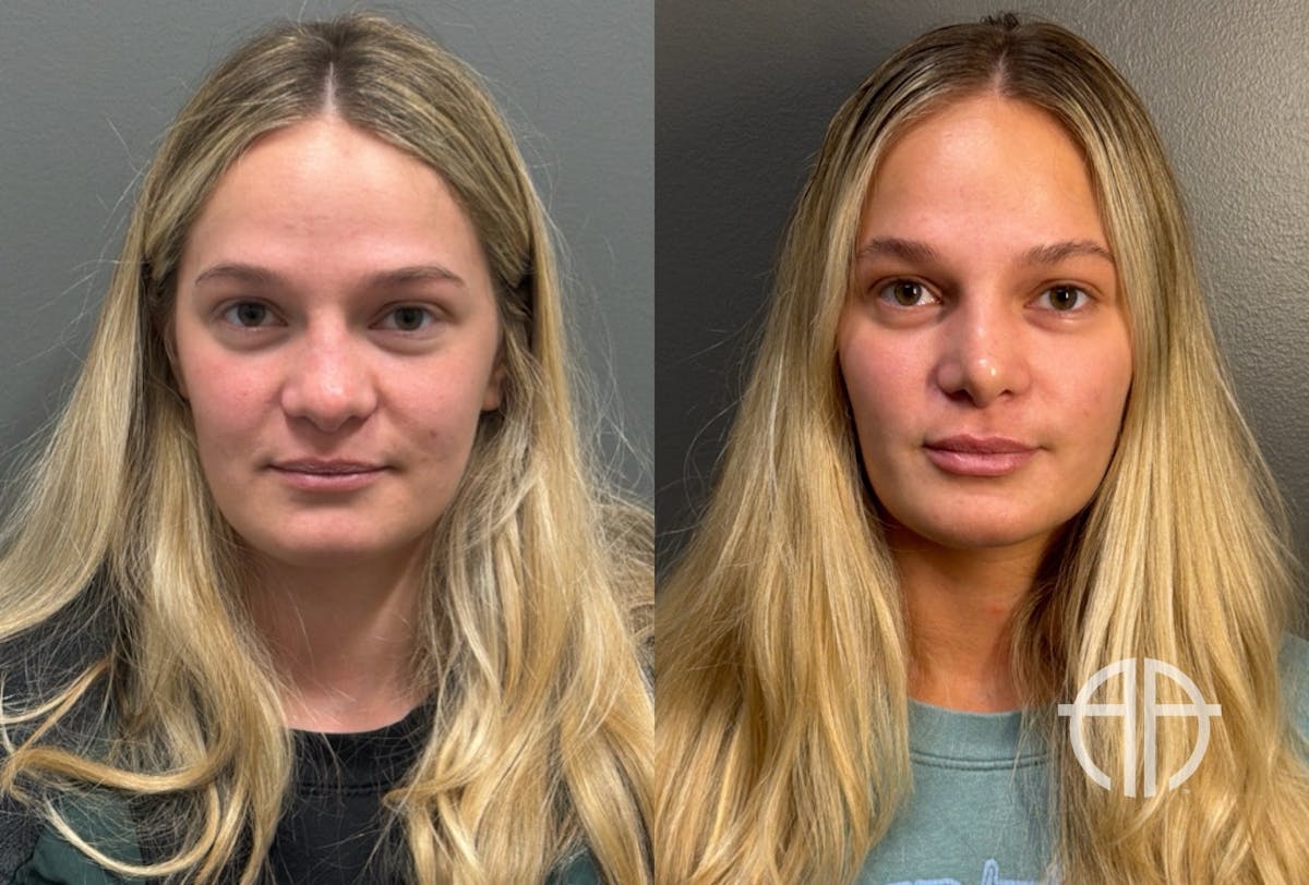 RHINOPLASTY Before & After Gallery - Patient 402620 - Image 1