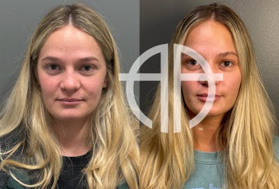 RHINOPLASTY Before & After Gallery - Patient 402620 - Image 1