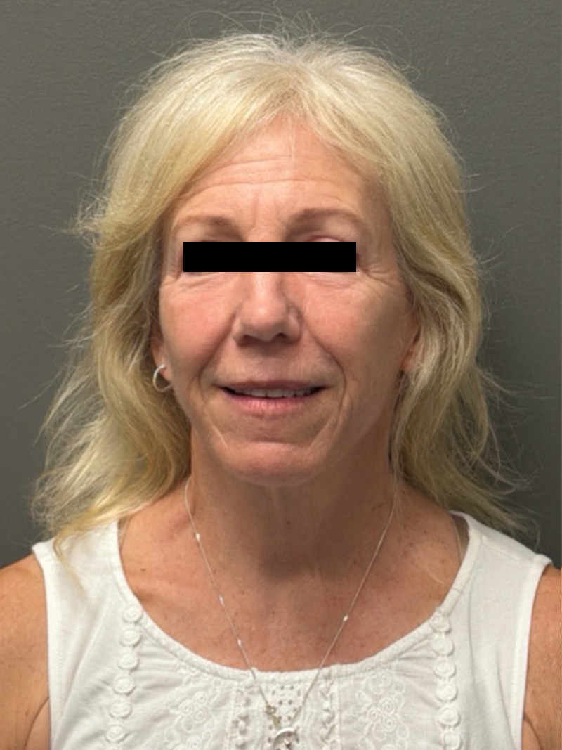 FACELIFT Before & After Gallery - Patient 141837 - Image 2