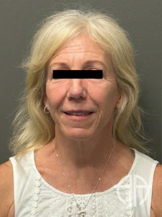 FACELIFT Before & After Gallery - Patient 141837 - Image 2