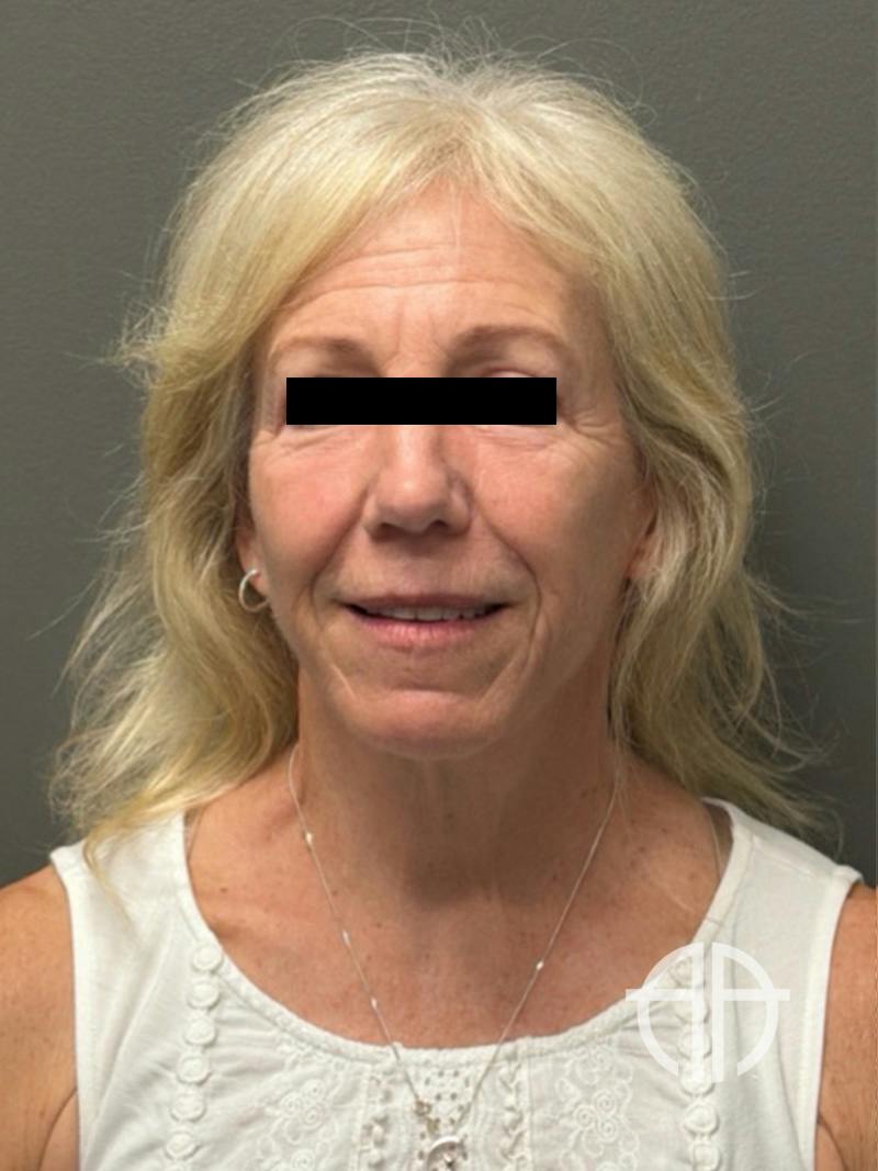 FACELIFT Before & After Gallery - Patient 141837 - Image 2