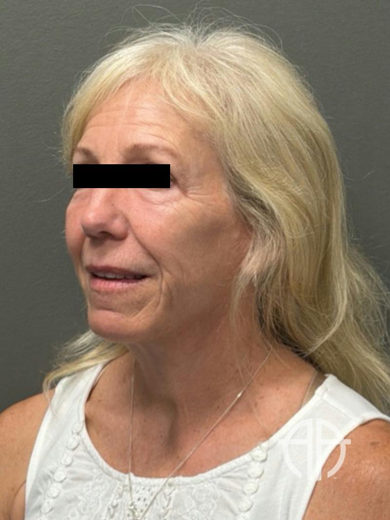FACELIFT Before & After Gallery - Patient 141837 - Image 8