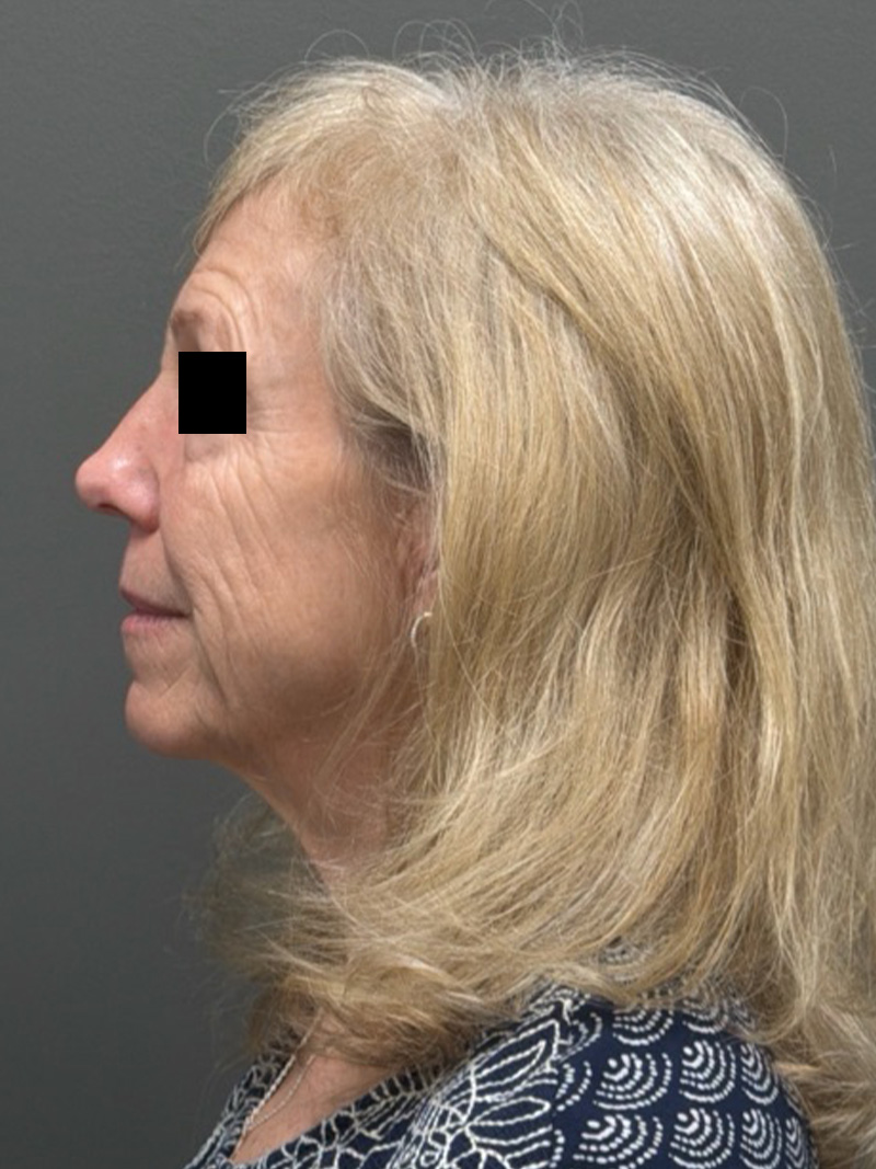 FACELIFT Before & After Gallery - Patient 141837 - Image 9