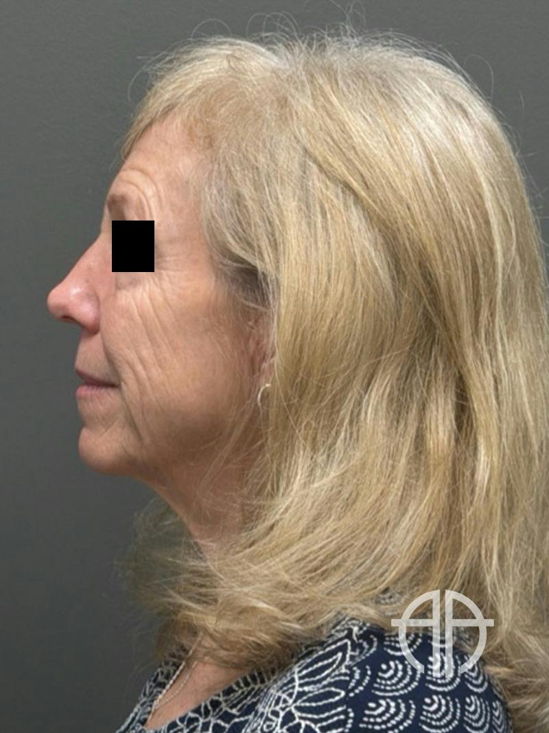 FACELIFT Before & After Gallery - Patient 141837 - Image 9