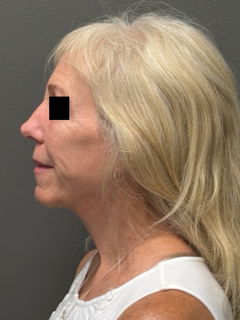 FACELIFT Before & After Gallery - Patient 141837 - Image 10