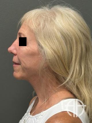 FACELIFT Before & After Gallery - Patient 141837 - Image 10