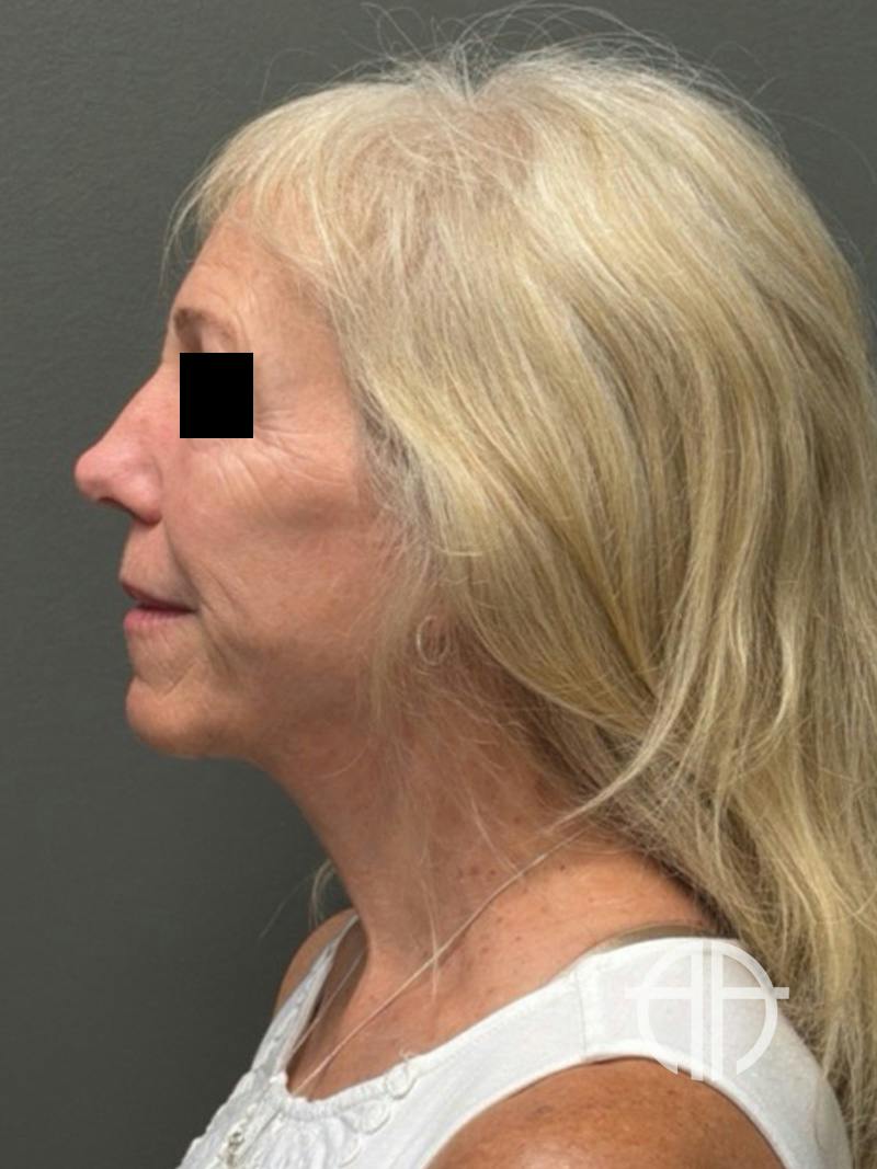 FACELIFT Before & After Gallery - Patient 141837 - Image 10