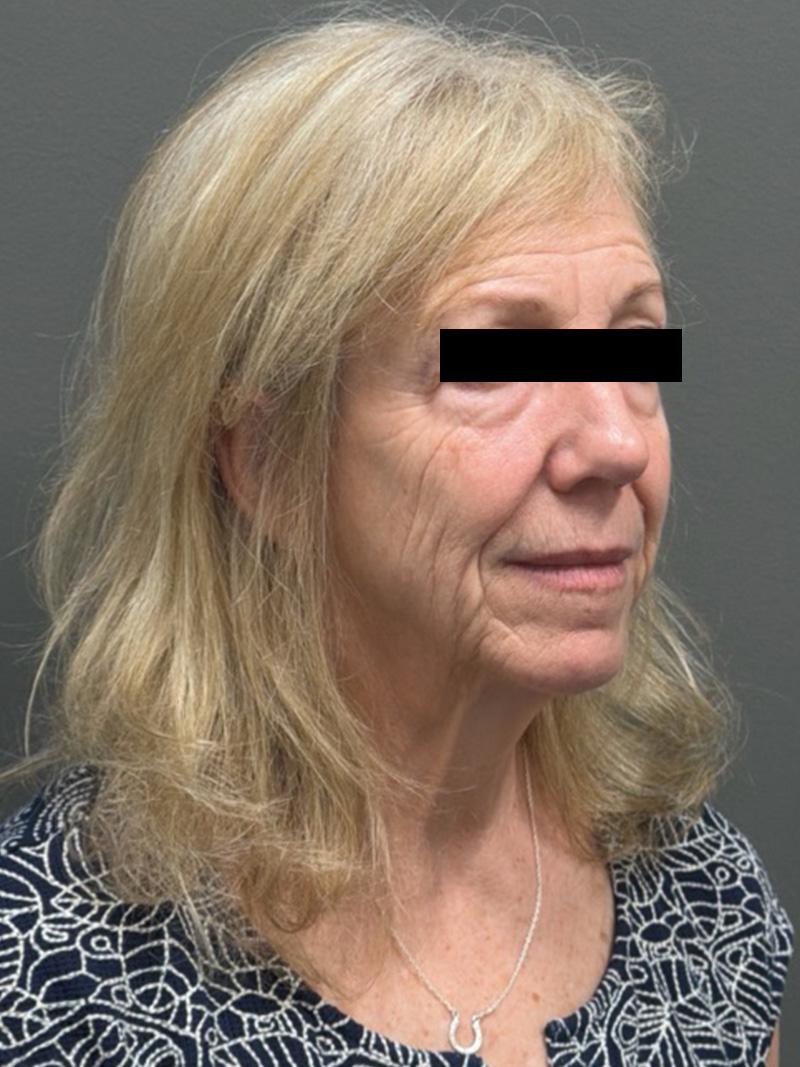 FACELIFT Before & After Gallery - Patient 141837 - Image 3