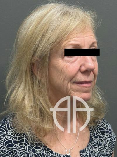 NECK LIFT Before & After Gallery - Patient 193130 - Image 1