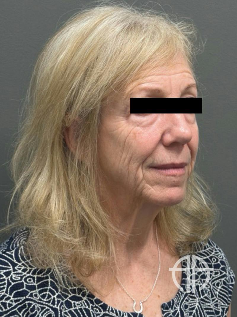 FACELIFT Before & After Gallery - Patient 141837 - Image 3