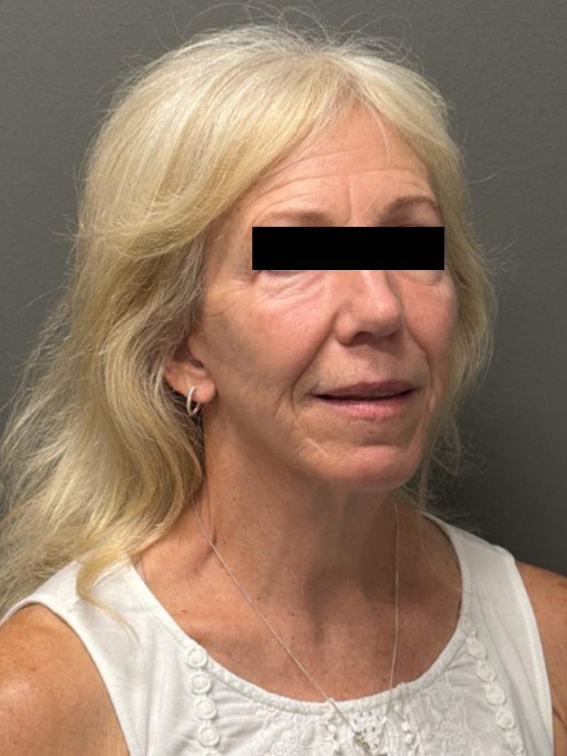 FACELIFT Before & After Gallery - Patient 141837 - Image 4