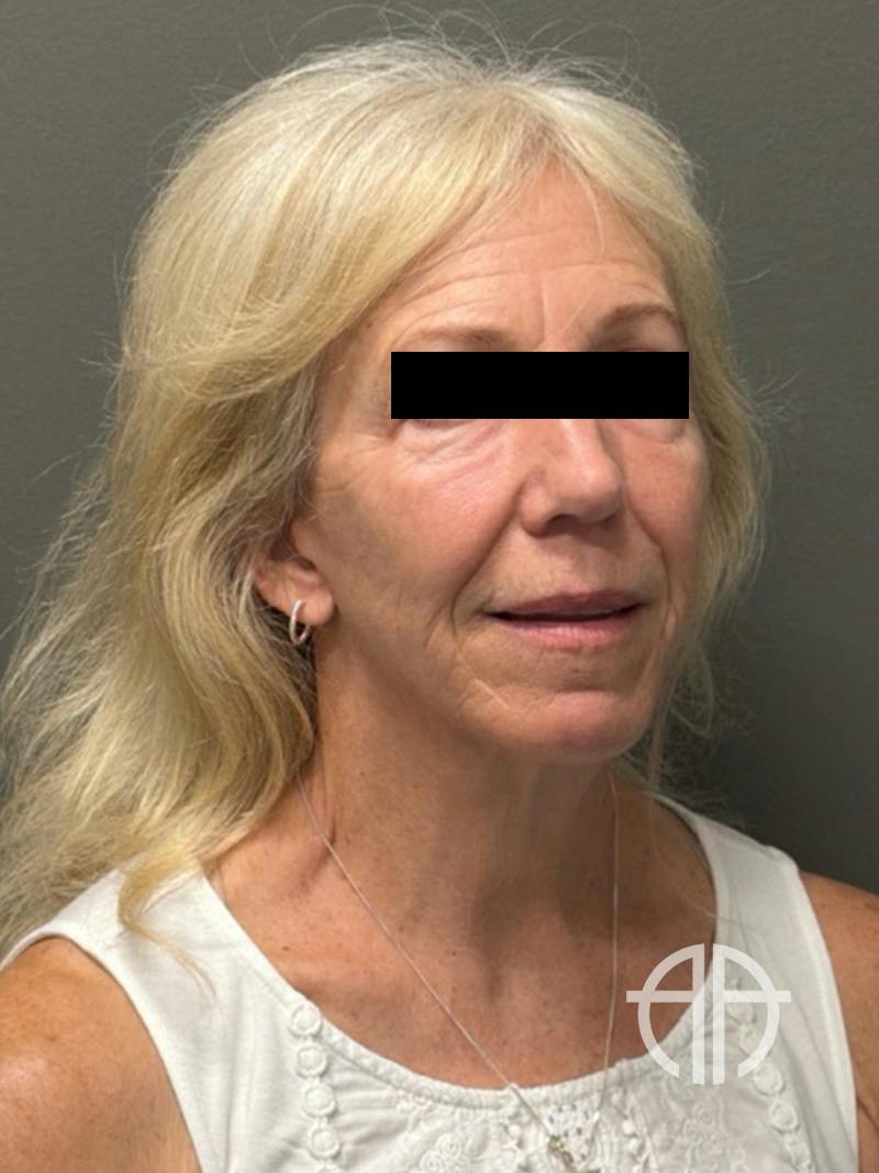FACELIFT Before & After Gallery - Patient 141837 - Image 4