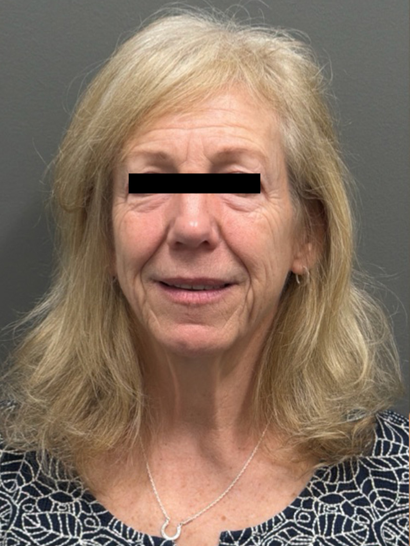 FACELIFT Before & After Gallery - Patient 141837 - Image 1