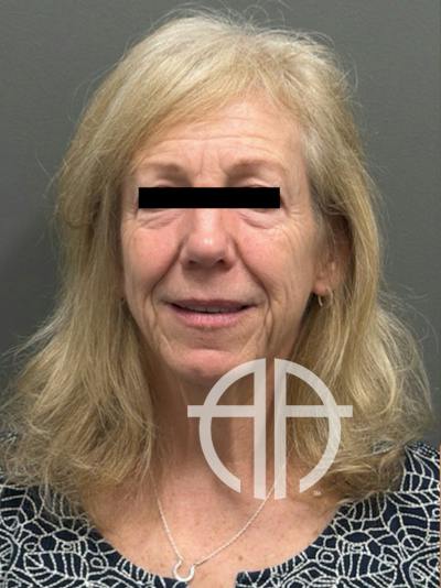 FACELIFT Before & After Gallery - Patient 141837 - Image 1