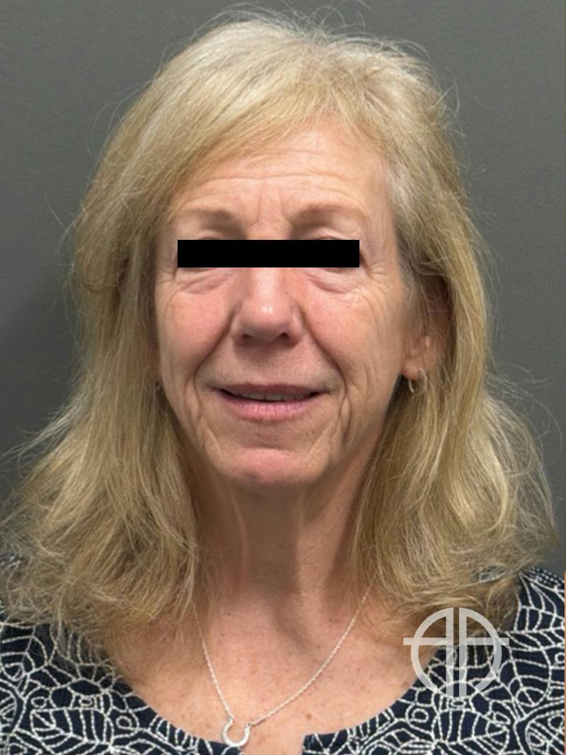 FACELIFT Before & After Gallery - Patient 141837 - Image 1